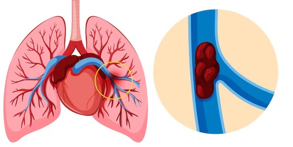 Những điều cần biết về việc tập thể dục trong quá trình hồi phục sau thuyên tắc phổi