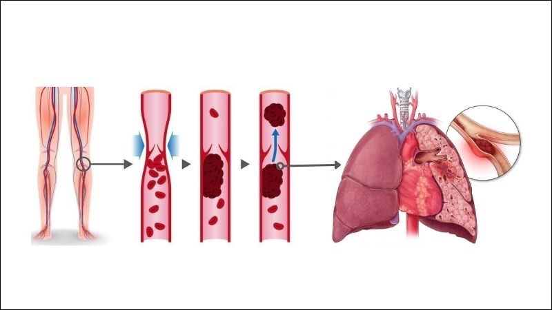 Các biến chứng của thuyên tắc phổi