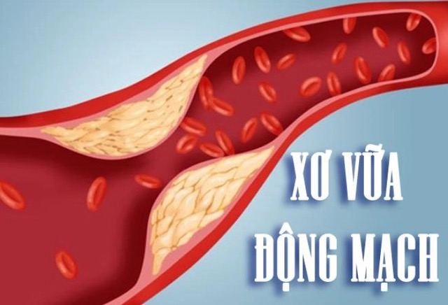 Bệnh xơ vữa động mạch có thể chữa khỏi được không?
