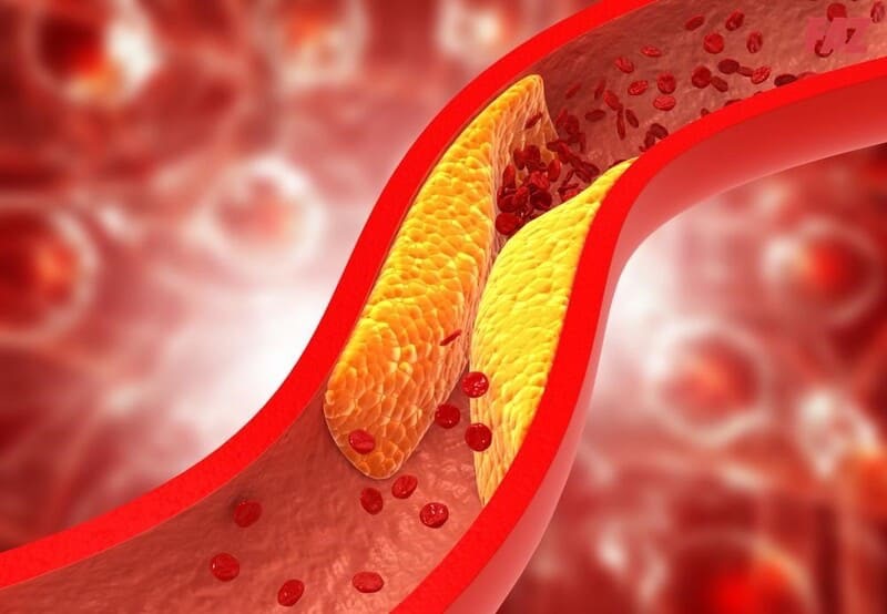 Xơ vữa động mạch: Dấu hiệu, nguyên nhân, rủi ro và điều trị