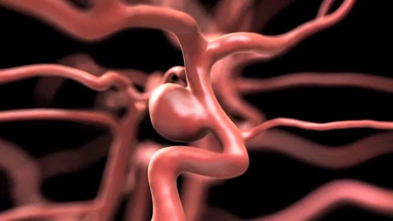 Phình động mạch não là gì? Triệu chứng, nguyên nhân, chẩn đoán và điều trị?