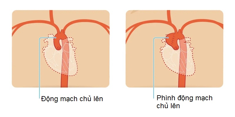 Phình động mạch chủ lên có tiên lượng ra sao?
