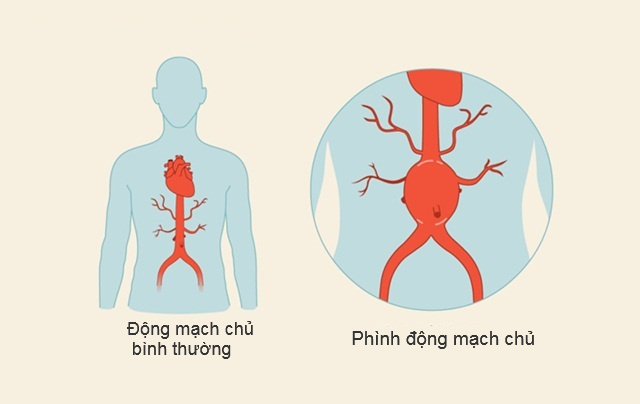 Phình động mạch chủ bụng: Triệu chứng và phương pháp điều trị