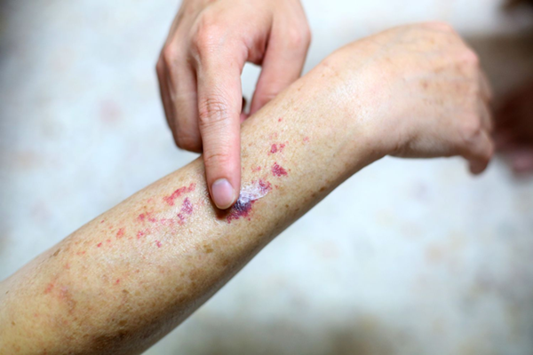 Triệu chứng và phương pháp điều trị viêm mạch hoại tử