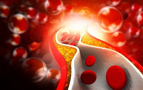 Rối loạn lipid máu: Những điều cần biết về cholesterol và triglyceride cao