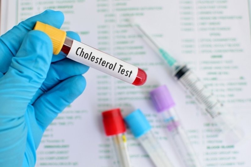 Tìm hiểu về xét nghiệm cholesterol (Lipid Panel)