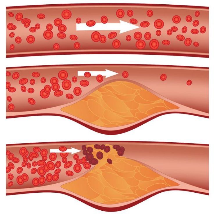 Những điều cần biết về cholesterol và tình trạng tích tụ mảng bám trong động mạch
