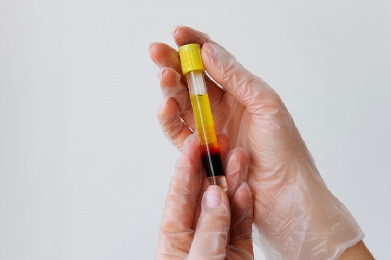 Khi nào cần nhịn ăn trước khi xét nghiệm mỡ máu (xét nghiệm cholesterol)?