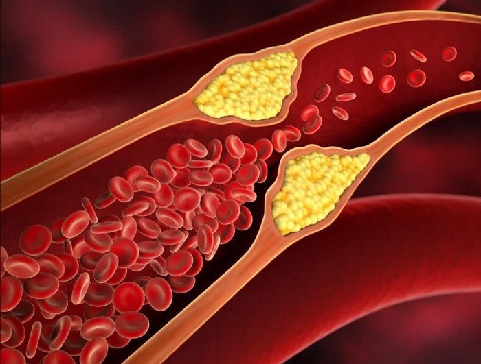 Vì sao có mức triglyceride cao nhưng mức cholesterol lại bình thường?