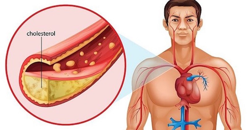 Người trẻ có thể bị cholesterol cao không?