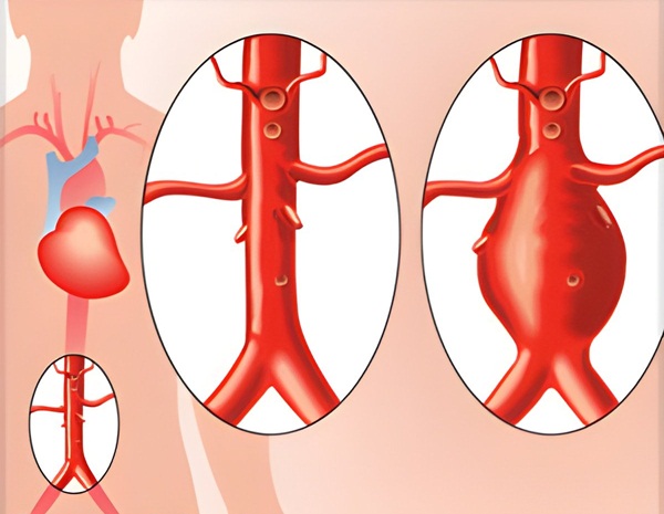 Huyết khối động mạch chủ: Triệu chứng, phương pháp điều trị và biến chứng