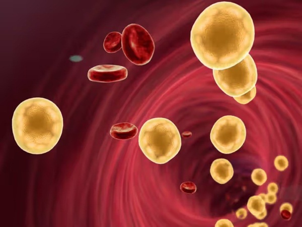 Rối loạn lipid máu: Cholesterol và triglyceride trong máu cao