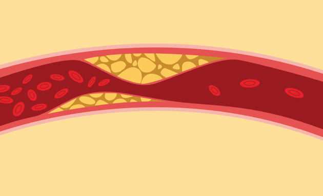 Tăng cholesterol máu (cholesterol cao): Triệu chứng, nguyên nhân và cách điều trị