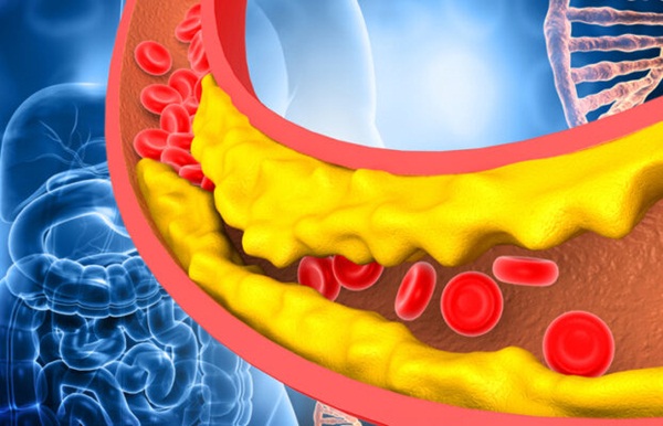 Tăng lipid máu: Nguyên nhân, triệu chứng và cách điều trị