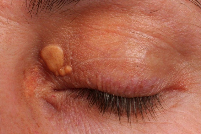 U vàng quanh mắt: Nguyên nhân và cách điều trị