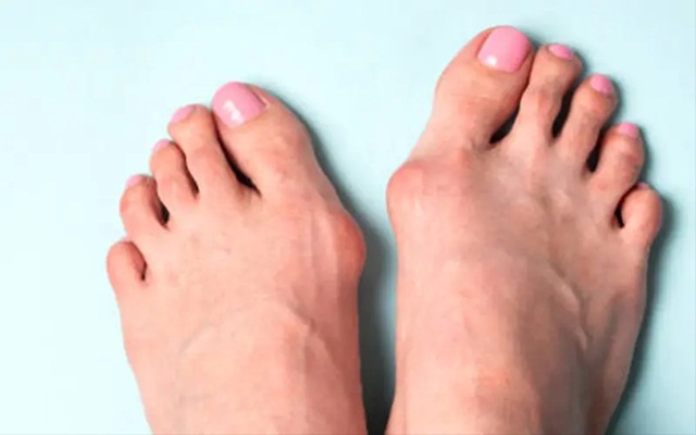Biến dạng ngón chân cái: Nguyên nhân, biến chứng và điều trị