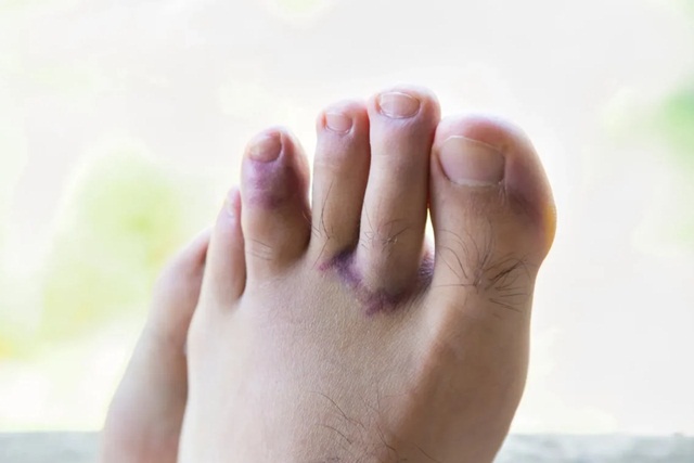 Gãy xương ngón chân