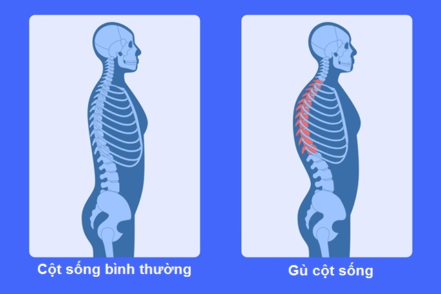 Phương pháp chữa trị gù cột sống