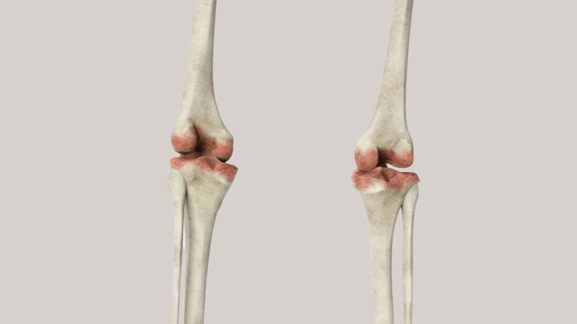 Sarcoma xương là bện gì? Điều trị bằng cách nào?