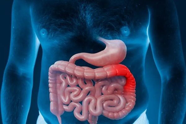 Viêm loét đại tràng: Triệu chứng, nguyên nhân và cách điều trị