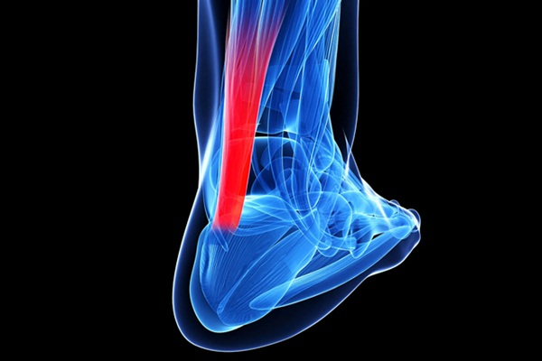 Viêm gân Achilles: Nguyên nhân và cách điều trị