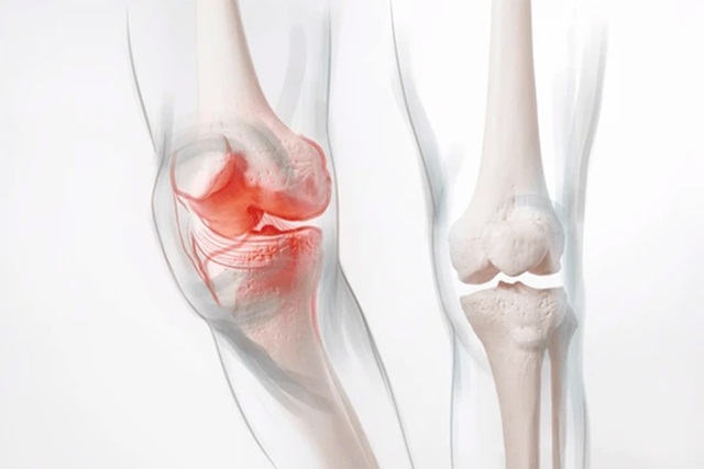 Viêm khớp nhiễm trùng: Triệu chứng và phương pháp điều trị