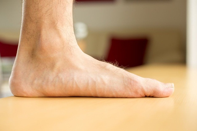 Bàn chân bẹt điều trị bằng cách nào?