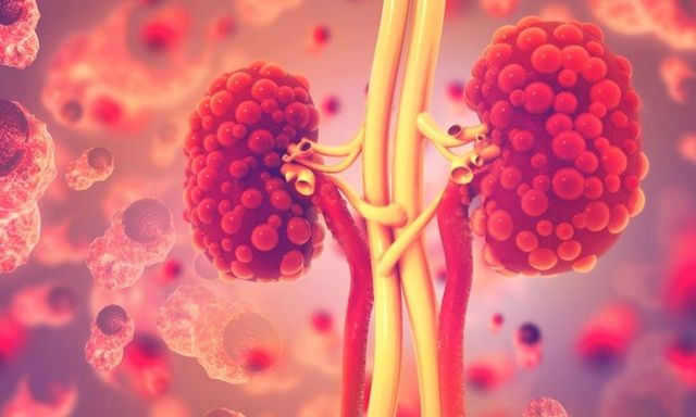 Bệnh thận đa nang: Nguyên nhân, chẩn đoán và cách điều trị