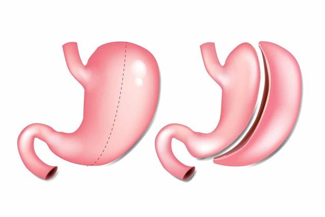 Khi Nào Cần Phẫu Thuật Cắt Dạ Dày?
