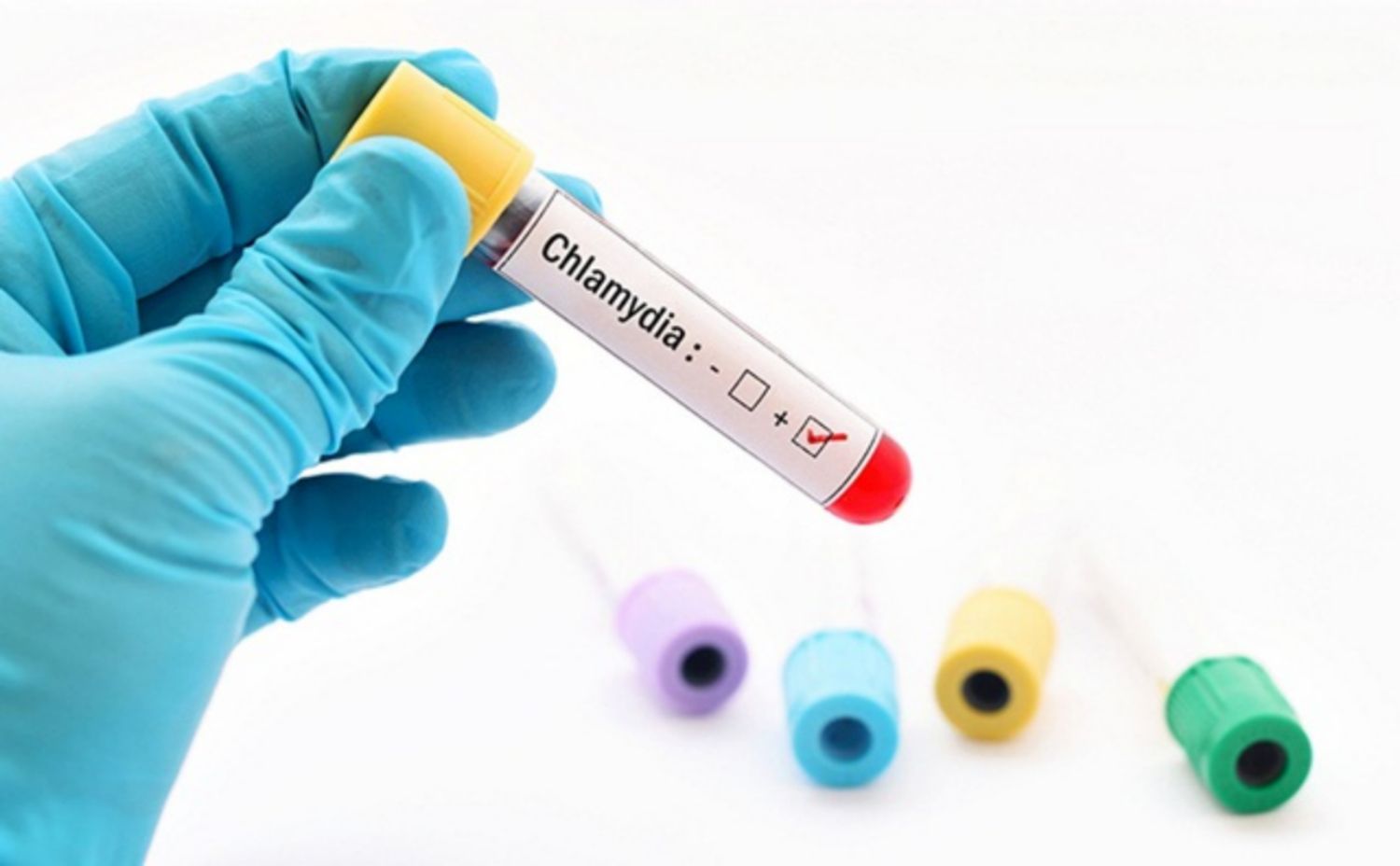 Những ai nên làm xét nghiệm chlamydia?