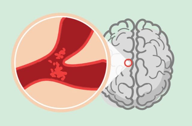 Đột quỵ tắc mạch là gì?