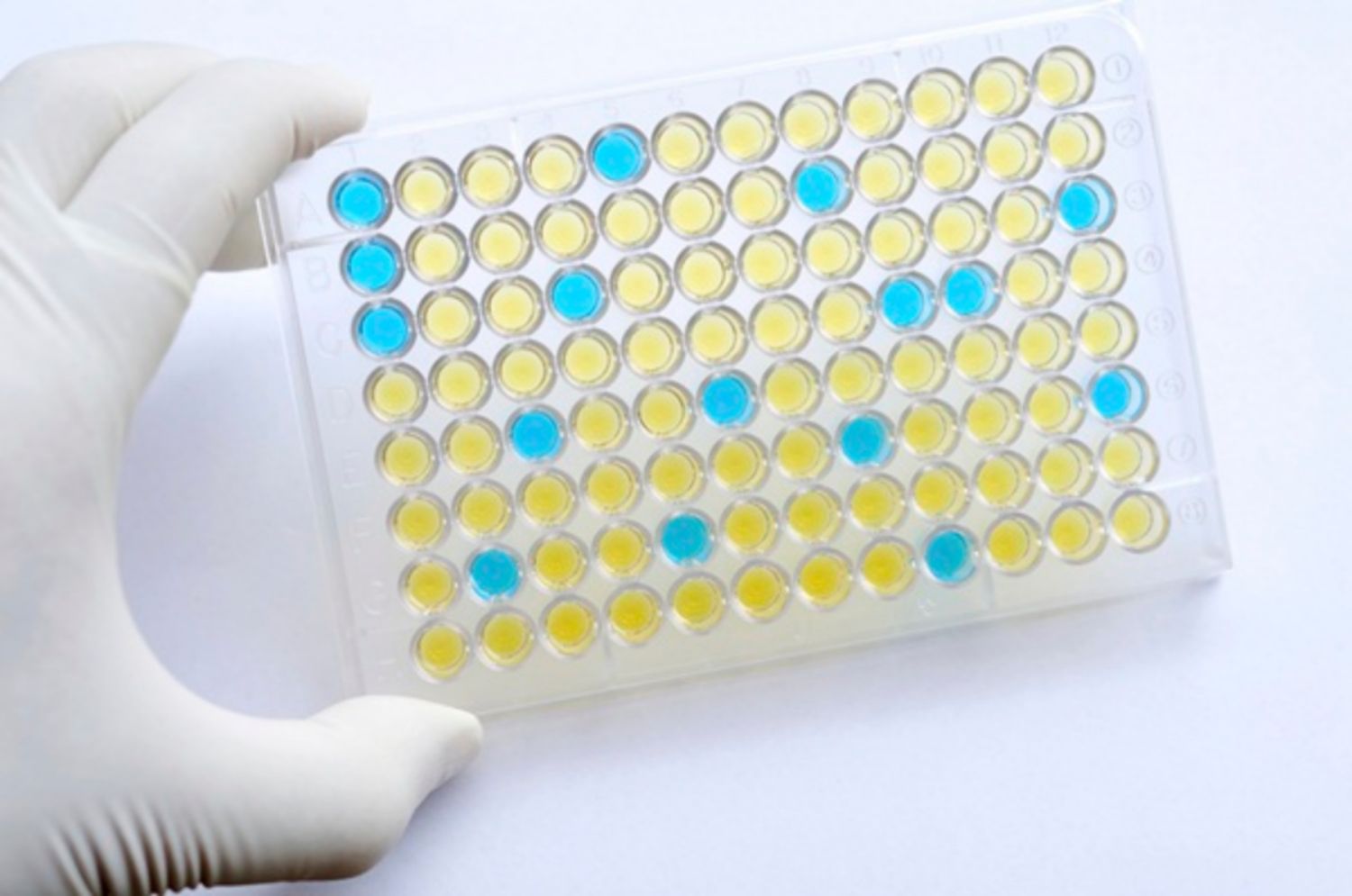 Xét nghiệm ELISA để chẩn đoán HIV