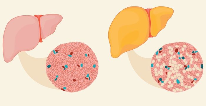 Gan nhiễm mỡ không do rượu: Biểu hiện và cách điều trị
