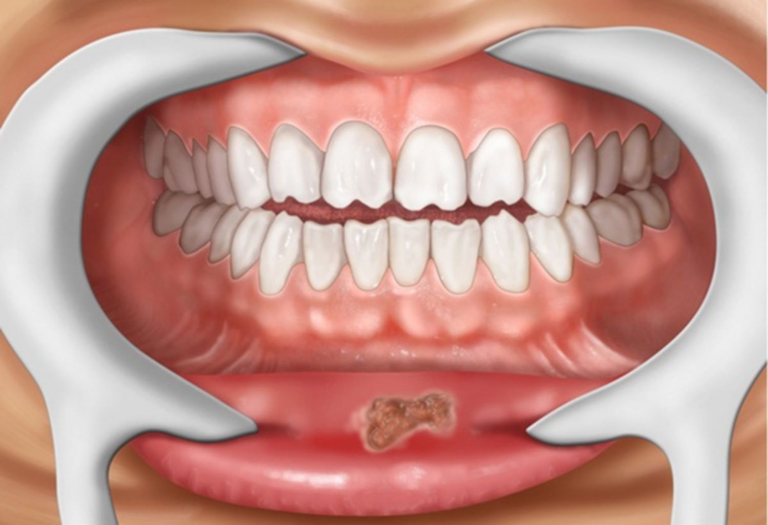Nguyên nhân gây bệnh giang mai ở miệng và cách điều trị