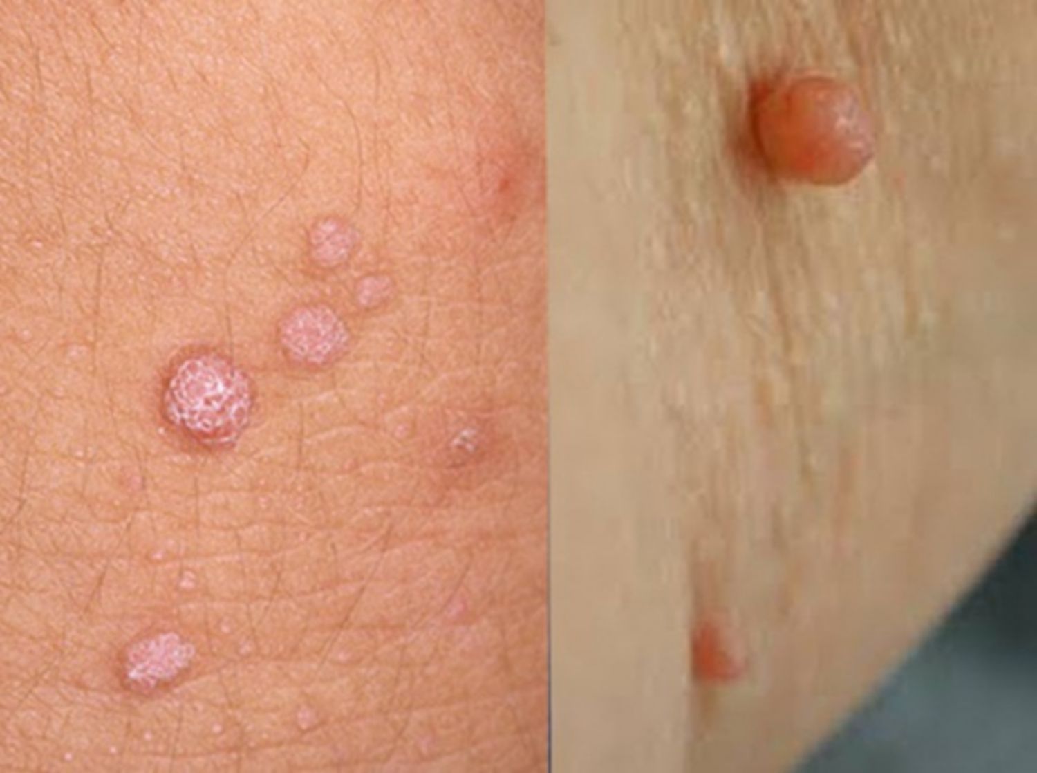 Phân Biệt Mụn Thịt Và Mụn Cóc Sinh Dục Như Thế Nào?