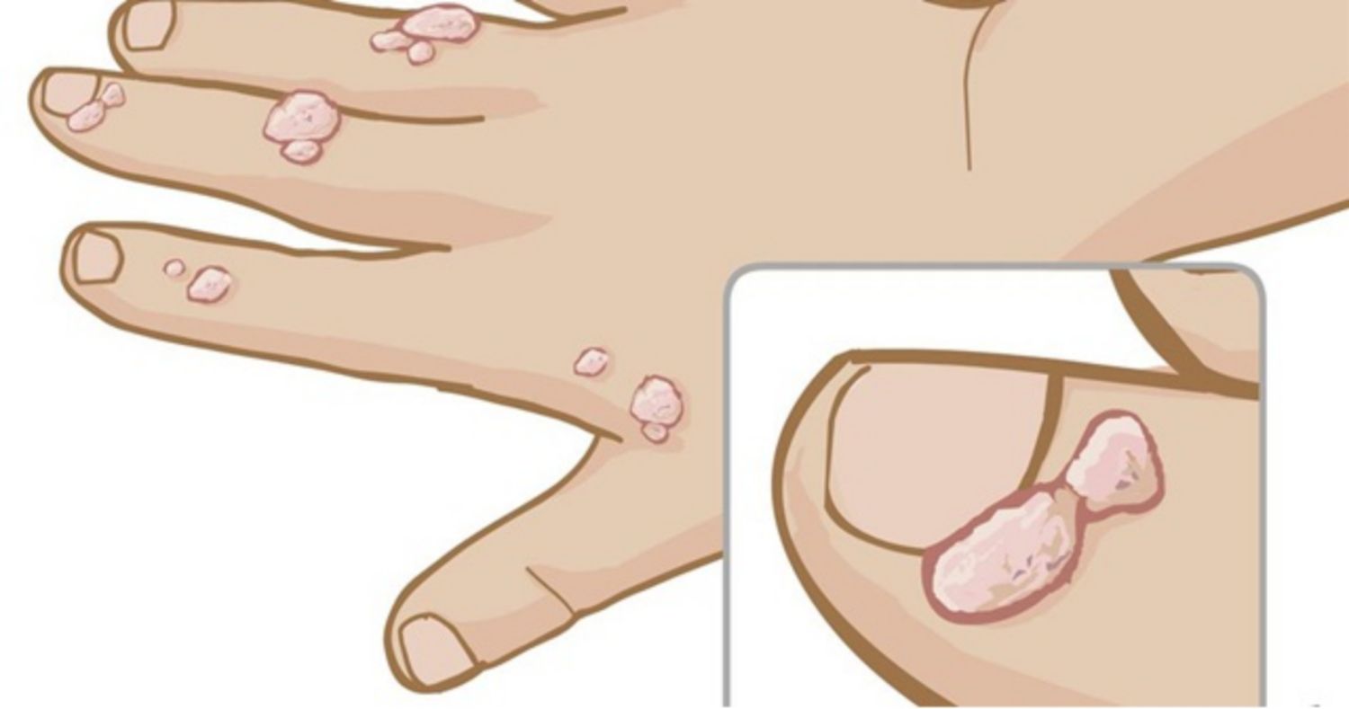Điều trị mụn cóc quanh móng bằng cách nào?