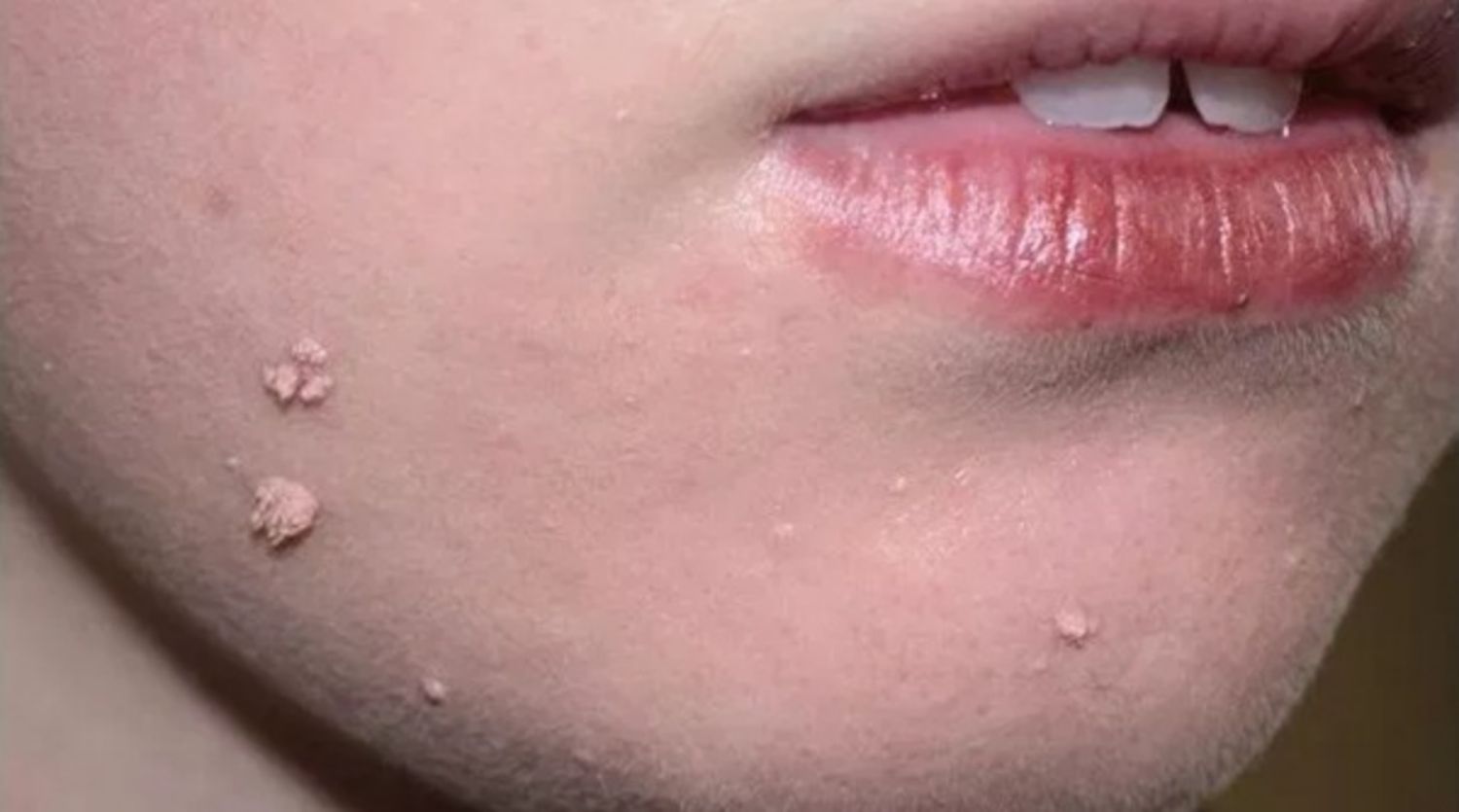 Mụn cóc dạng sợi mảnh: Nguyên nhân, đặc điểm và cách xử lý