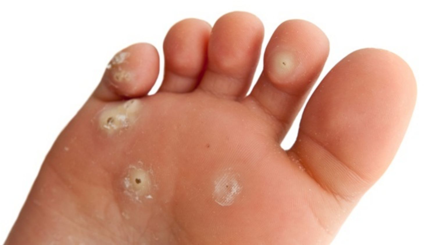 Cách Ngăn Ngừa Mụn Cóc Và Vết Chai Có Thể Bạn Chưa Biết