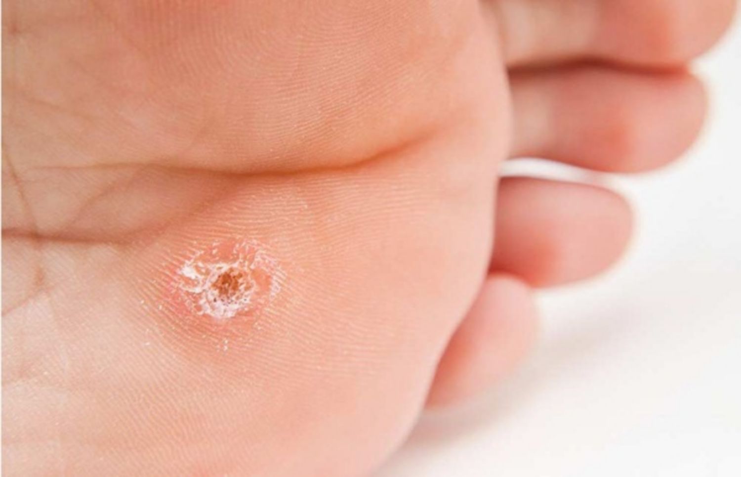 Điều trị và ngăn ngừa mụn cóc Plantar