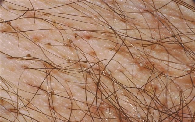 Cách Trị Rận Mu Bằng Cách Nào?