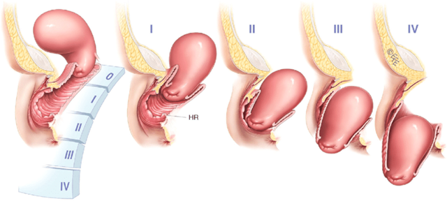 Sa tử cung: Biểu hiện và cách điều trị