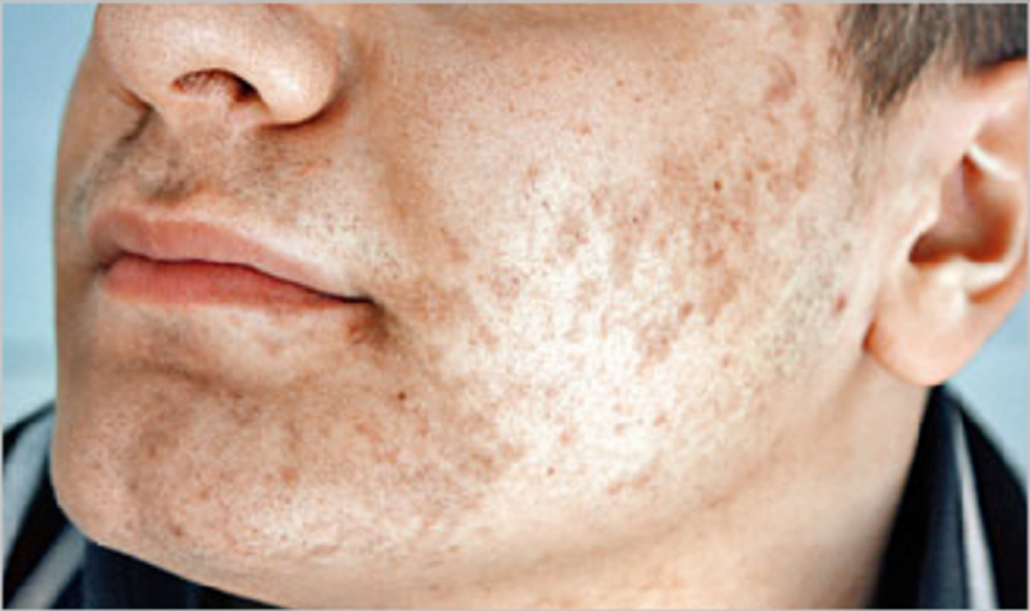 Xử lý sẹo do mụn rộp