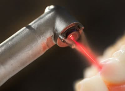 Sử dụng laser trong nha khoa