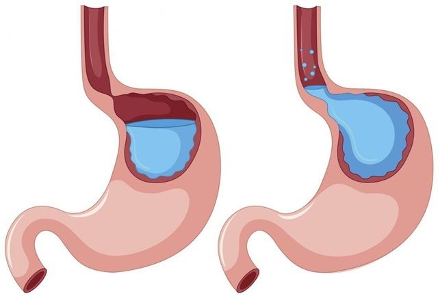 Trào ngược axit có những triệu chứng nào?