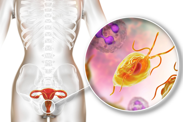 Nhiễm trichomonas: Nguyên nhân, dấu hiệu và cách điều trị