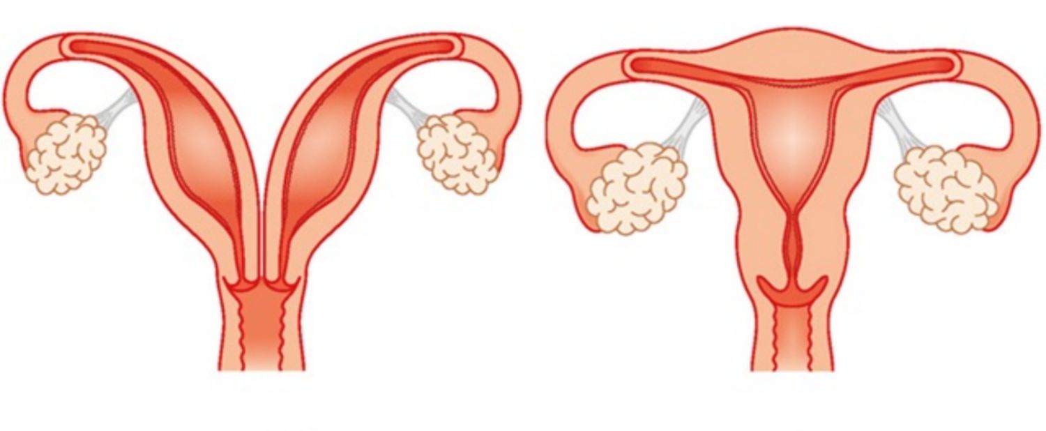 Tử cung đôi là gì và có ảnh hưởng đến khả năng sinh sản không?