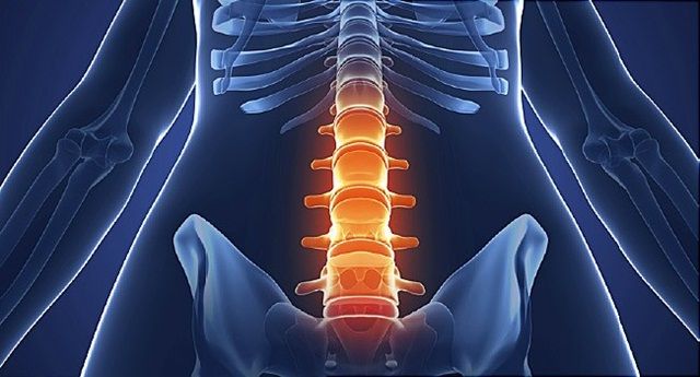 Viêm cột sống dính khớp: Nguyên nhân và cách điều trị