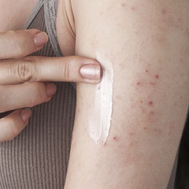Viêm da cơ địa ảnh hưởng tiêu cực đến chất lượng cuộc sống như thế nào