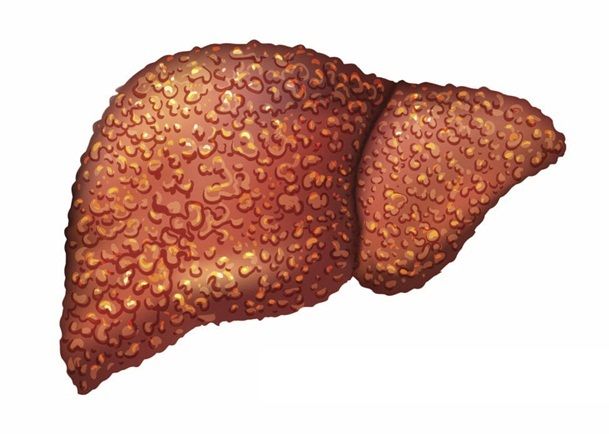 Viêm gan do rượu: Triệu chứng và cách điều trị