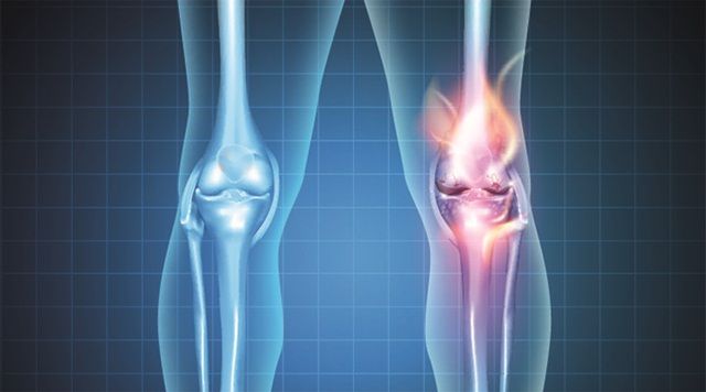 Viêm khớp phản ứng: Nguyên nhân và cách điều trị